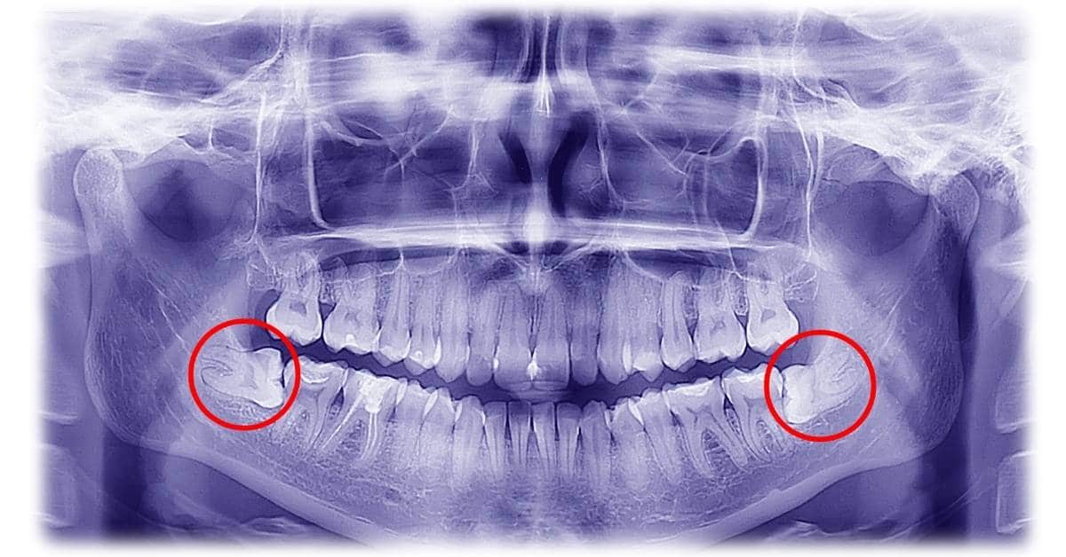 Drückt zahnfleisch weisheitszahn gegen Zahnfleisch: Schmerzen
